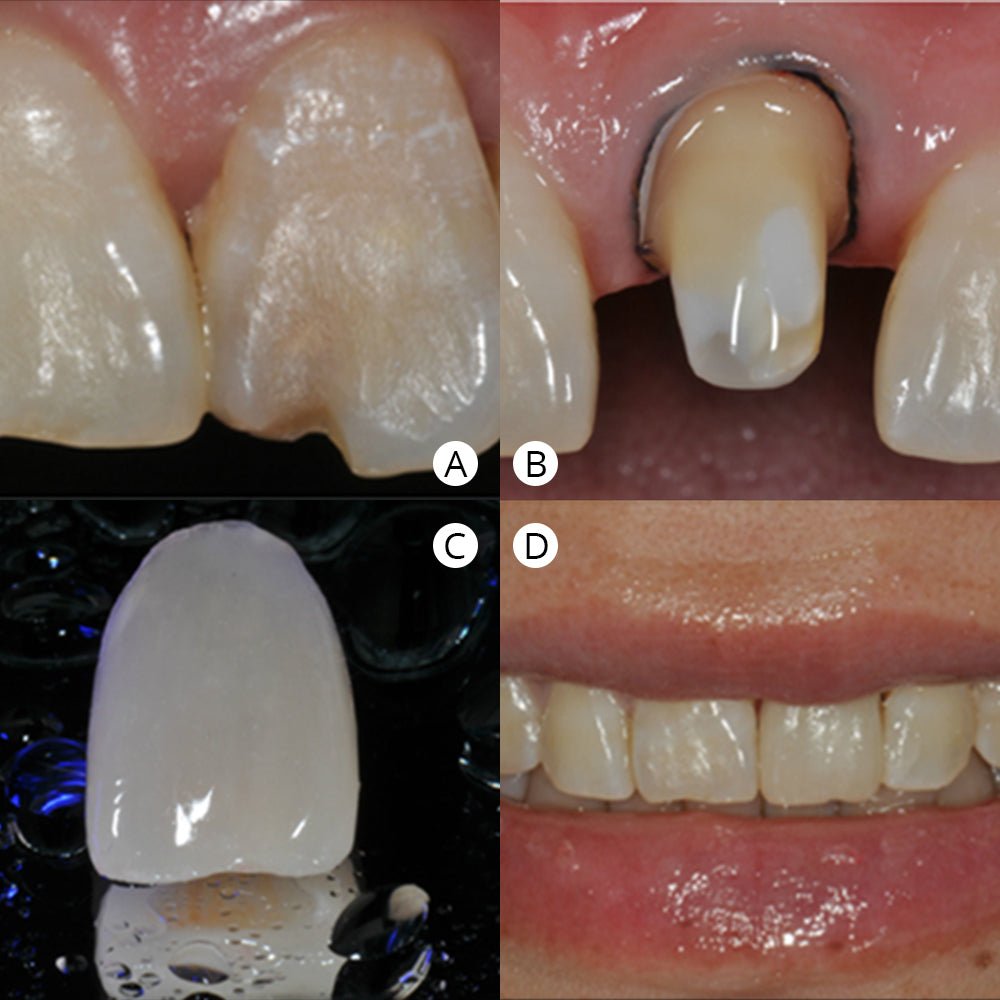 Hybrid Ceramic Multilayer—M14(12*14*18mm)-HT(5 pieces) - CeraDirect